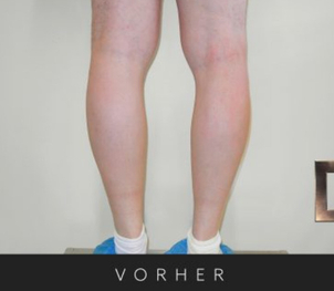 Vergrößerung mittels Implantat - Dr. Georg M. Huemer MSc, MBA