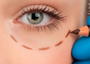 Die Blefaroplastik des Unterlides ist eine nahezu komplikationsfreie OP