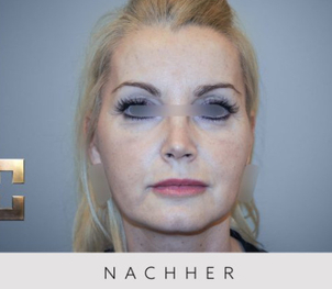 Nach der Nasenverschmälerung - Dr. Georg M. Huemer