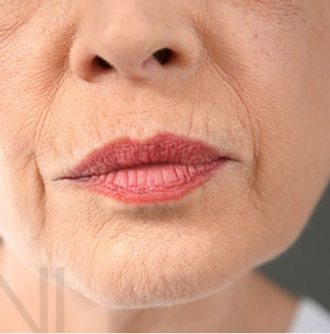 Zur Korrektur von Falten wird Hyaluronsäure weltweit eingesetzt - Dr. med. Nikolaus Linde