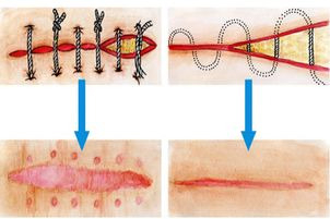Schema zur chirurgischen Narbenentfernung