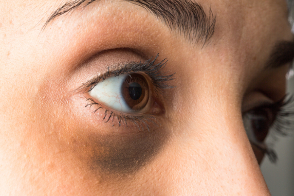 Dunkle Augenringe sind ein häufiges ästhetisches Problem