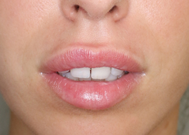 Natürliche Ergebnisse der Lippenvergrößerung sind aktuell gefragt - Dr.med. Thorsten Sattler