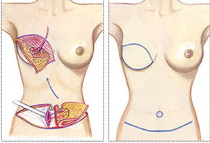 Vorgehensweise einer Brustrekonstruktion - Ethanium Heidelberg.