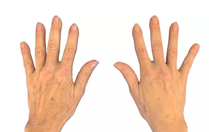 Ergebnis einer Handverjüngung - Dr.med. Rolf Bartsch