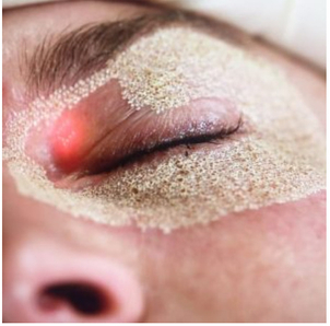 Der CO2 Fraktional Laser stimuliert das Bindegewebe und kontrahiert die kollagenen Fasern - Dr. med. Yusuf Yildirim