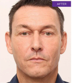 Wie funktioniert Botulinumtoxin?