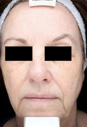 Für wen ist eine Entfernung geeignet?