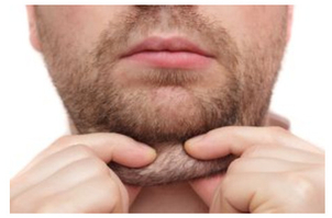 Übergewicht ist nicht immer der Auslöser für ein Doppelkinn