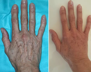 Vorher-Nachher einer Handverjüngung - Dr. Nikolaus Redtenbacher