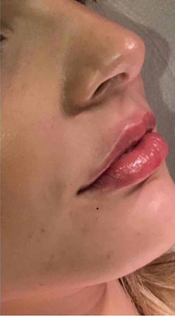 Nachher Aufnahme einer dezenten Lippenunterspritzung