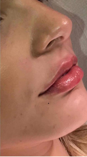 Nachher Aufnahme einer dezenten Lippenunterspritzung