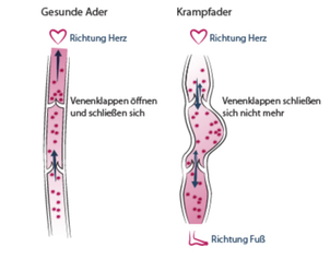 Gesunde und geschädigte Venen - Angioclinic