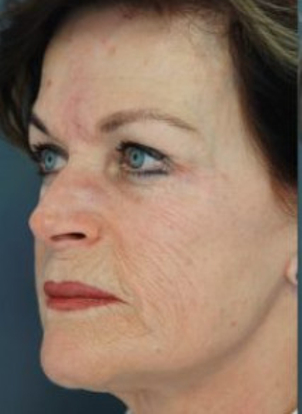 Chemische Peelings helfen den Hautton zu verfeinern und die -alterung zu mildern