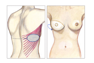 Latissimus dorsi Lappenplastik - Foto: ETHIANUM Heidelberg
