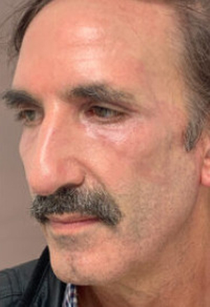 Wie viele Peeling Sitzungen sollten durchgeführt werden?