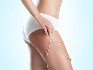 Chirurgische Striae-Entfernung