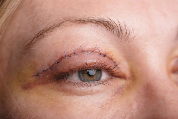 Risiken sind sehr selten bei Augenlid-Operationen