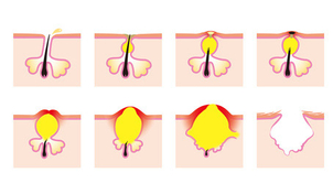 Talgabsonderung der Talgdrüsen führt zu Akne - CityPraxen Berlin