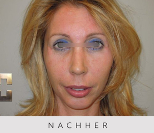 Nasenkorrektur - Dr. Georg M. Huemer