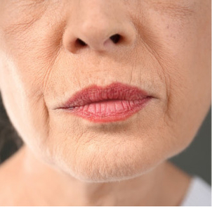 Lippenfalten