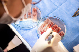 Bei der FUE Methode werden die Haare einzeln vom Chirurgen herausgelöst und in die Spenderregion verpflanzt