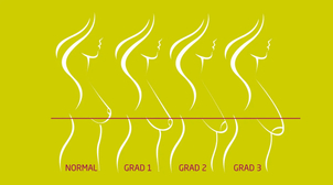 Es gibt unterschiedliche Schweregrade der Hängebrust