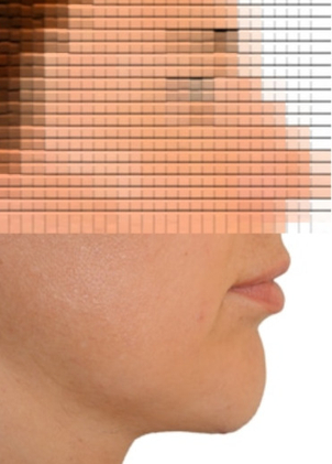 Kinnaugmentation mit Silikonimplantat - Univ. Prof. Dr. Edvin Turkof