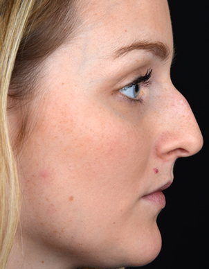 Nasennachkorrektur - Dr. med. Thomas Fasching