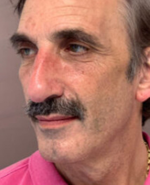 Vorher Fotos des Phenol-Peelings - Dr. Dr. med. Frank Muggenthaler