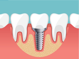 Aus ästhetischer Sicht stellen Zahnimplantate einen perfekten Ersatz der natürlichen Zähne dar