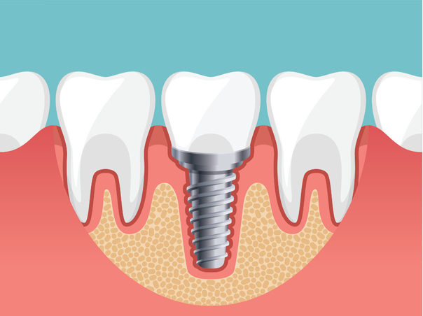 Aus ästhetischer Sicht stellen Zahnimplantate einen perfekten Ersatz der natürlichen Zähne dar﻿﻿