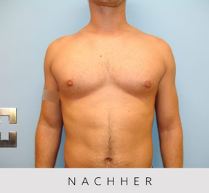 Nach der Korrektur der Männerbrust -  Dr. Georg M. Huemer