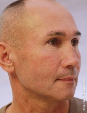 Durch die Anhebung der Augenbrauen ist der Blick wieder wach und klar - Foto: Muggenthaler Ästhetik