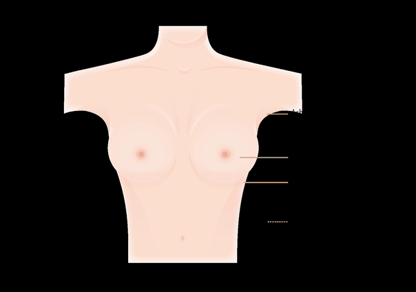 Schnittführung einer Brustvergrößerung - Klinik am Rhein