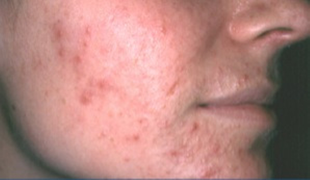 ﻿Akne kann in der Form von Mitessern bis hin zu schweren Pusteln und Entzündungen auftauchen - Hautarztpraxis Dr. Degenhardt