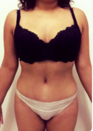 Nach einer Bauchdeckenstraffung verlieren Sie nicht nur überschüssige Haut, sondern formen auch die Silouette