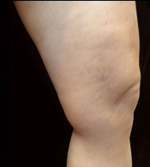 Krampfaderbehandlung Dr. Linde