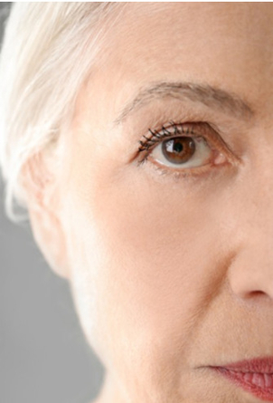 Nach der Korrektur der Augenringe