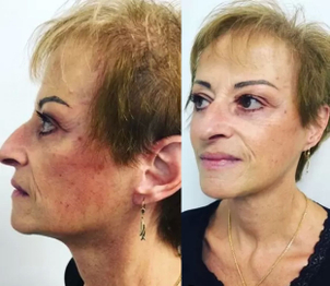 Patientin nach SMAS Facelift - Prof. Dr. med. Nektarios Sinis