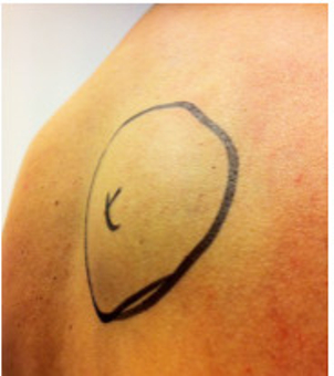 Am häufigsten werden Lipome durch Liposuktion oder eine Fett-weg-Spritze entfernt - Dr. med. Hans Martin Zoppelt