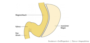 Der Chirurg entfernt einen Teil des Magens - AWMF