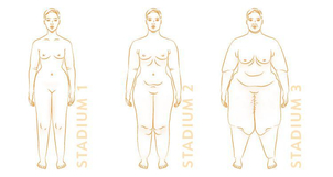 Die drei Stadien eines Lipödems