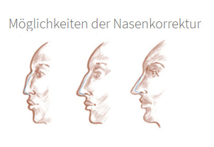 Eine Nase kann u.a. begradigt, verkleinert oder vergrößert werden - Dr. med. Sixtus Allert