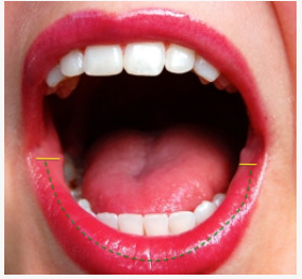 dauerhafte Lippenvergrößerung mit Permalip - Dr. med. Timo Spanholtz