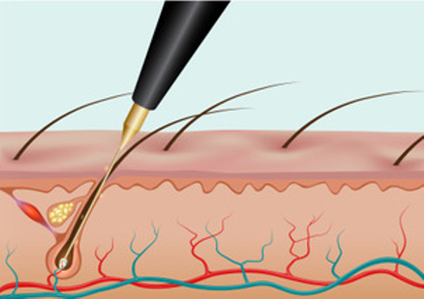 Die elektrische Nadel wird in den Haarfollikel eingeführt