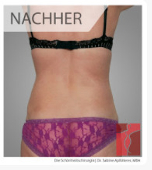 Vorher-Nachher Foto der Ultraschall Liposuktion durchgeführt von - Dr. Sabine Apfolterer MBA