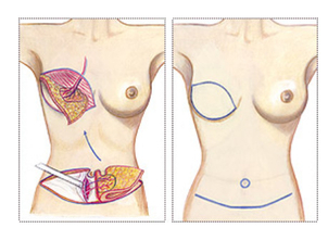 DIEP-Lappen-Methode (DIEP-FLAP) - Foto: ETHIANUM Heidelberg