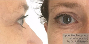 Ergebnis einer Oberlidstraffung - Dr.med. Rolf Bartsch