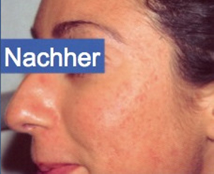 Es gibt sehr effektive Behandlungen zur Bekämpfung von Aknenarben - Hautarztpraxis Dr. Degenhardt